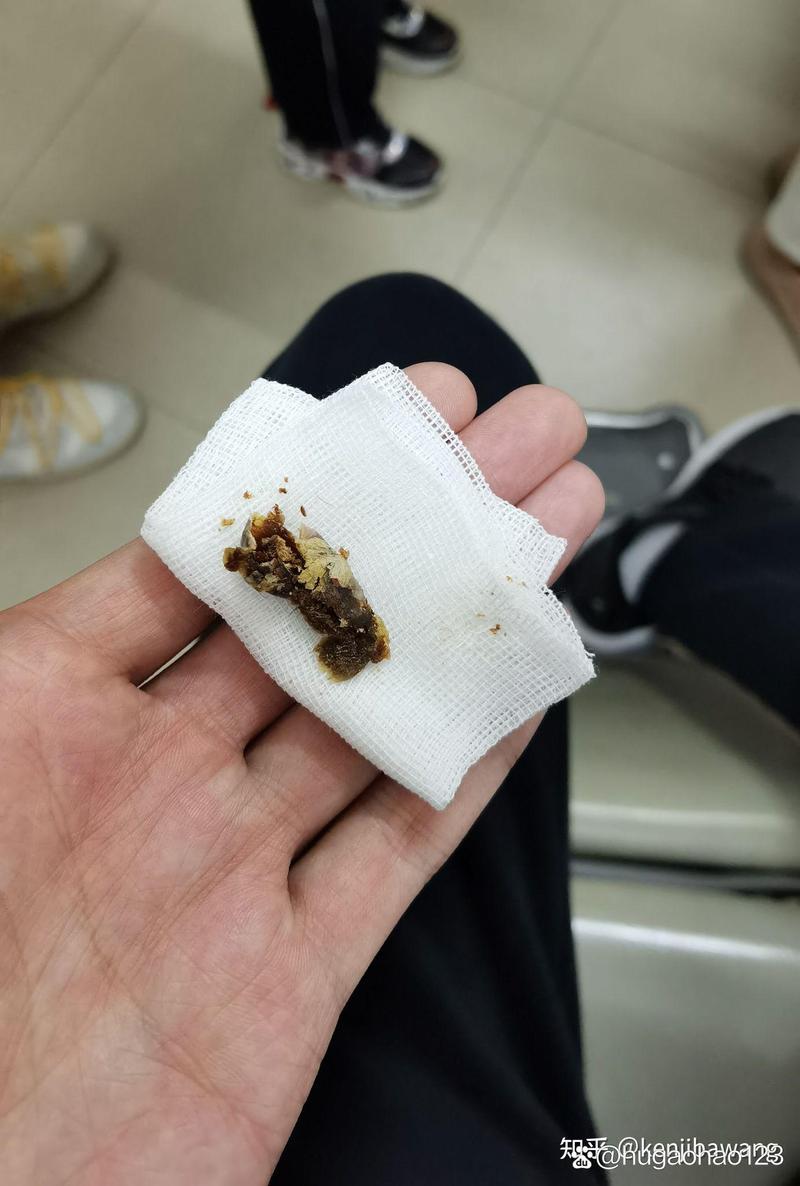 吃了耳屎会怎么样