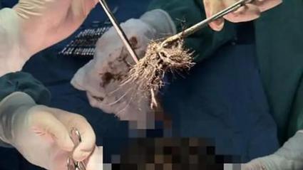15岁少女吃头发成瘾胃里取出4斤发石