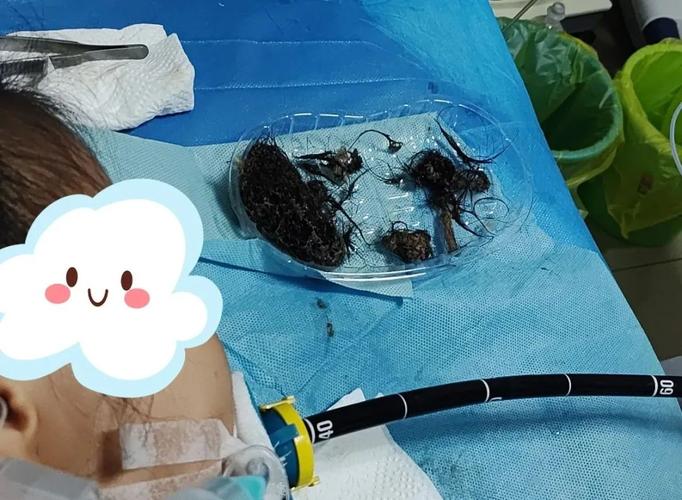 15岁少女吃头发成瘾胃里取出4斤发石