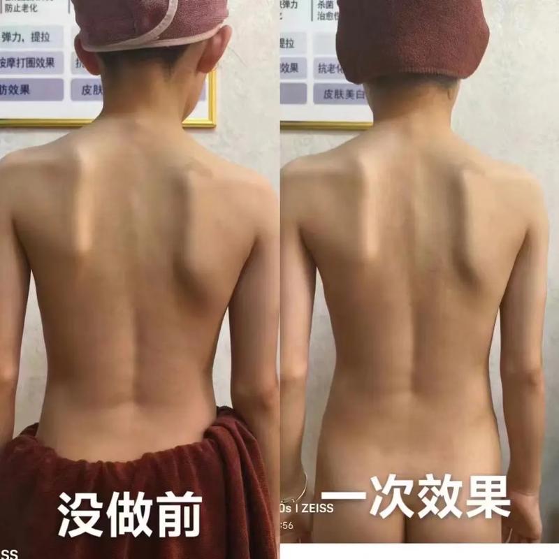 孩子“坐没坐相”可能是脊柱侧弯