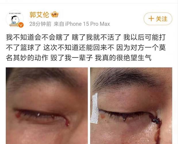 男子眼球被炸破 夏天很多人在用它
