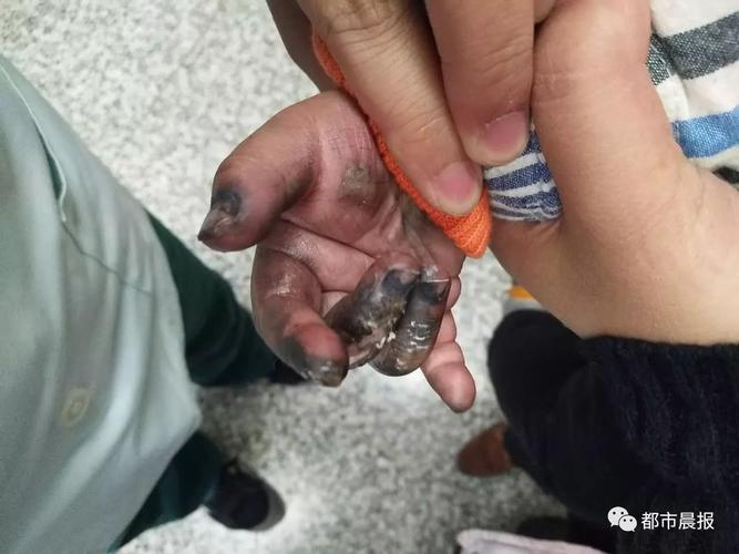 少年被干冰炸伤手指伤口深可见骨