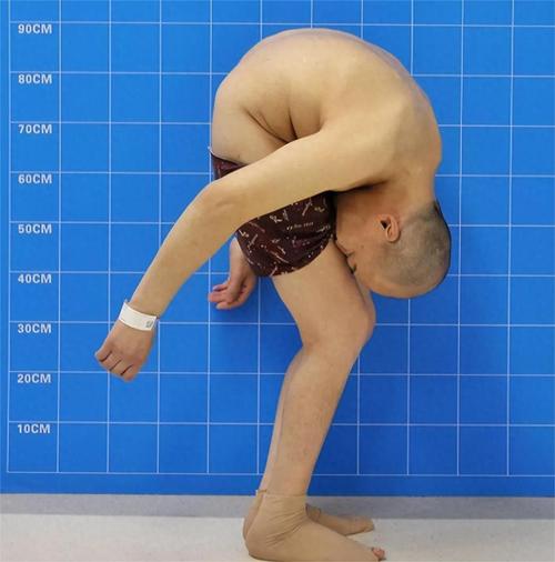 4次断骨打开折叠男孩迈出新生第一步