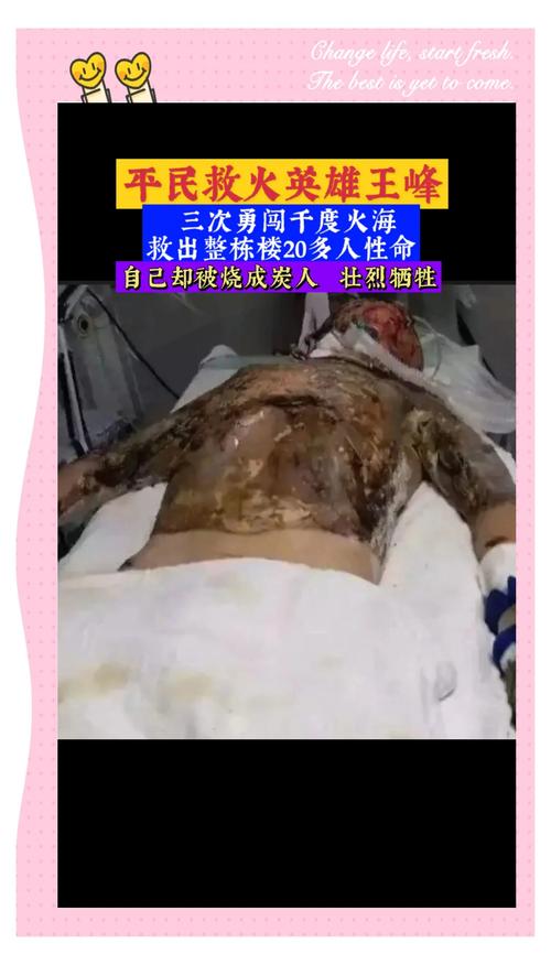 丈夫两次冲进火场救妻双双烧伤