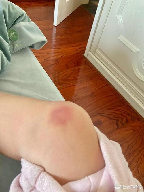 为何女生身体更容易出现淤青