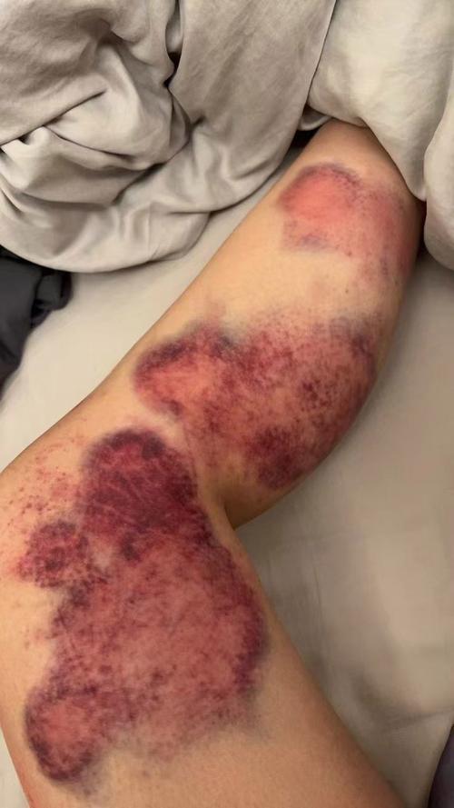 为何女生身体更容易出现淤青