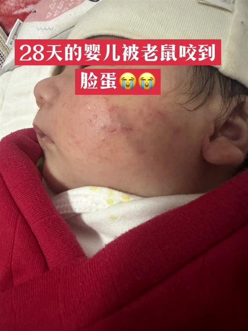 印度一医院2名新生儿被老鼠咬伤