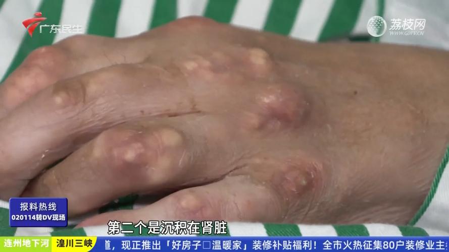 小伙豪饮火锅汤后痛风发作无法行走