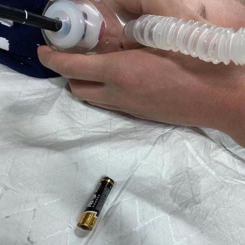 幼儿误吞电池10小时致终身残疾
