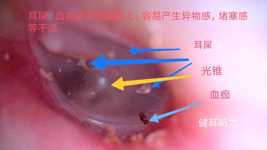 爸爸掏耳朵被孩子撞到致耳膜脱落