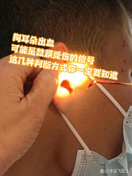 爸爸掏耳朵被孩子撞到致耳膜脱落