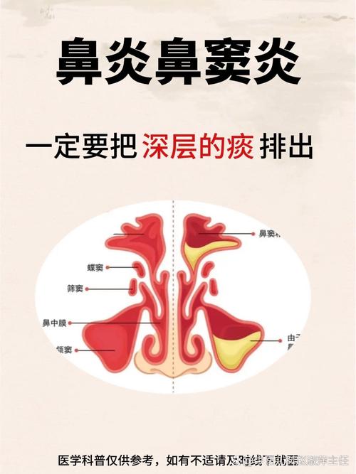 男子鼻窦炎多年竟是3厘米树枝藏鼻中