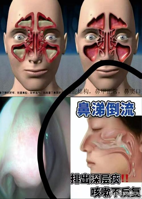 男子鼻窦炎多年竟是3厘米树枝藏鼻中