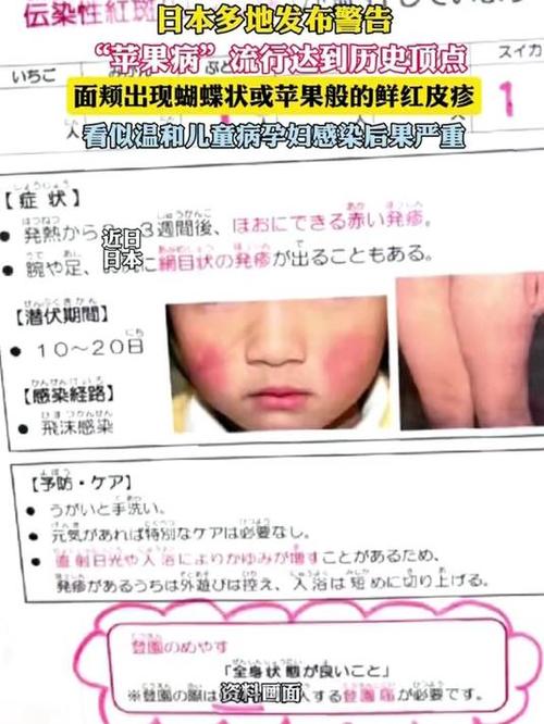 日本“苹果病”流行达历史顶点