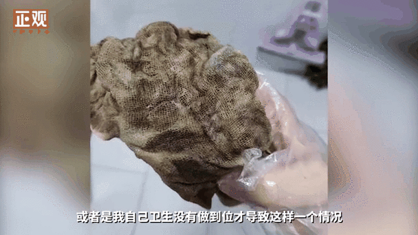 女子术后20天发现体内留纱布已发臭
