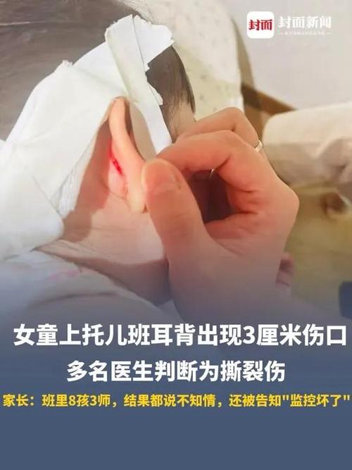 女童上托班耳朵疑被撕裂 家长发声