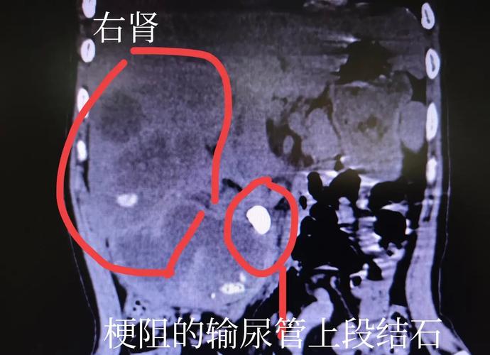 男子查出肾结石未重视拖成大麻烦