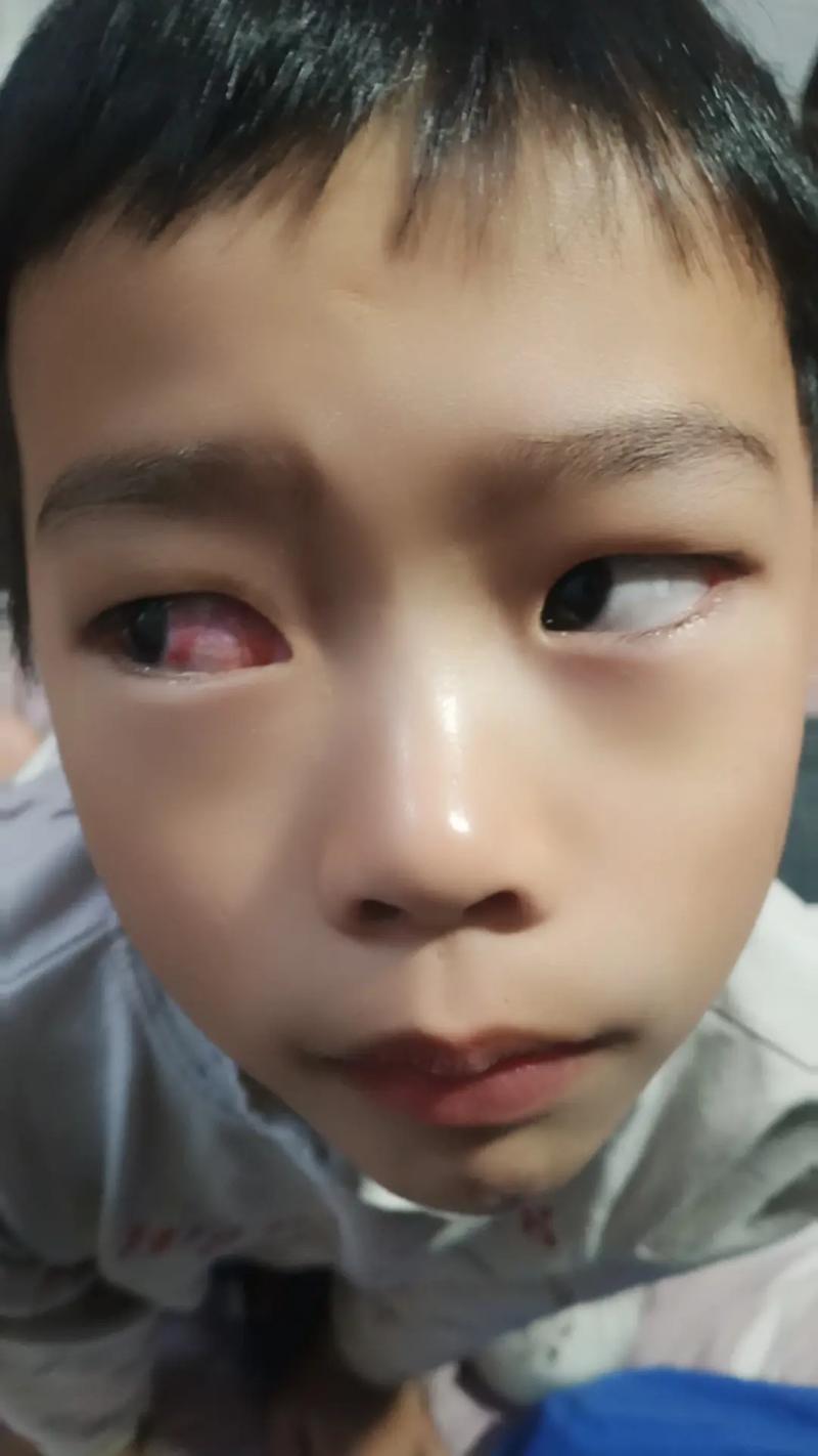 5岁男孩在幼儿园被戳伤致左眼失明
