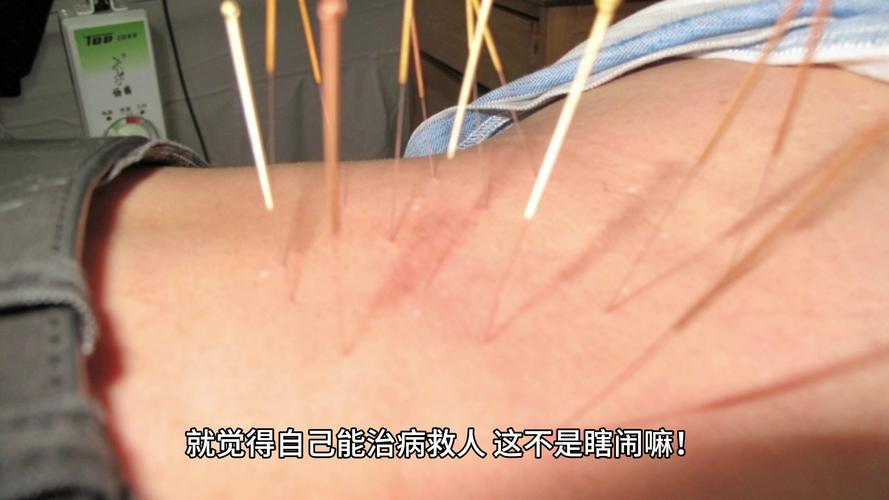 为了更熟练 医学生在自己身上练针灸