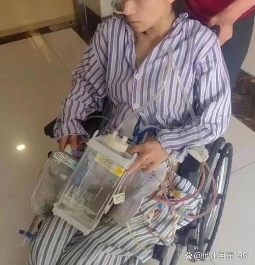 女子连吃好几个柿子致肠梗阻