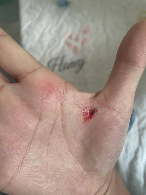 冬天咬人的蚊子已经出现了