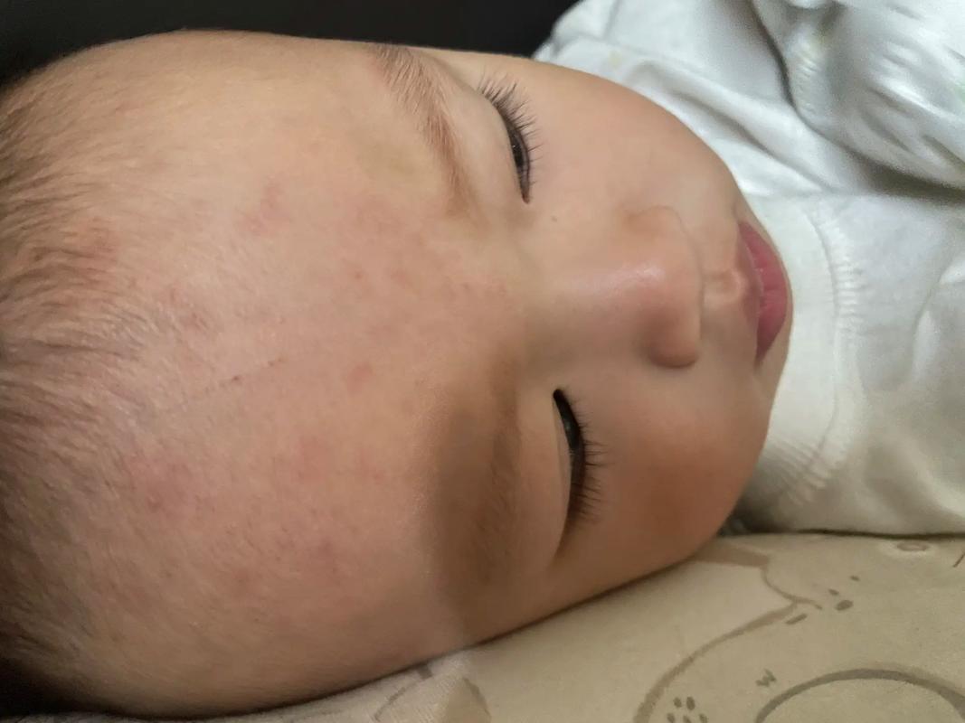 男孩发烧十几个小时 退烧后脸变黑